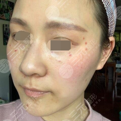 正規(guī)醫(yī)院激光祛斑多少錢？全面解析費(fèi)用因素，正規(guī)醫(yī)院激光祛斑費(fèi)用解析，多少錢？全面探討費(fèi)用因素