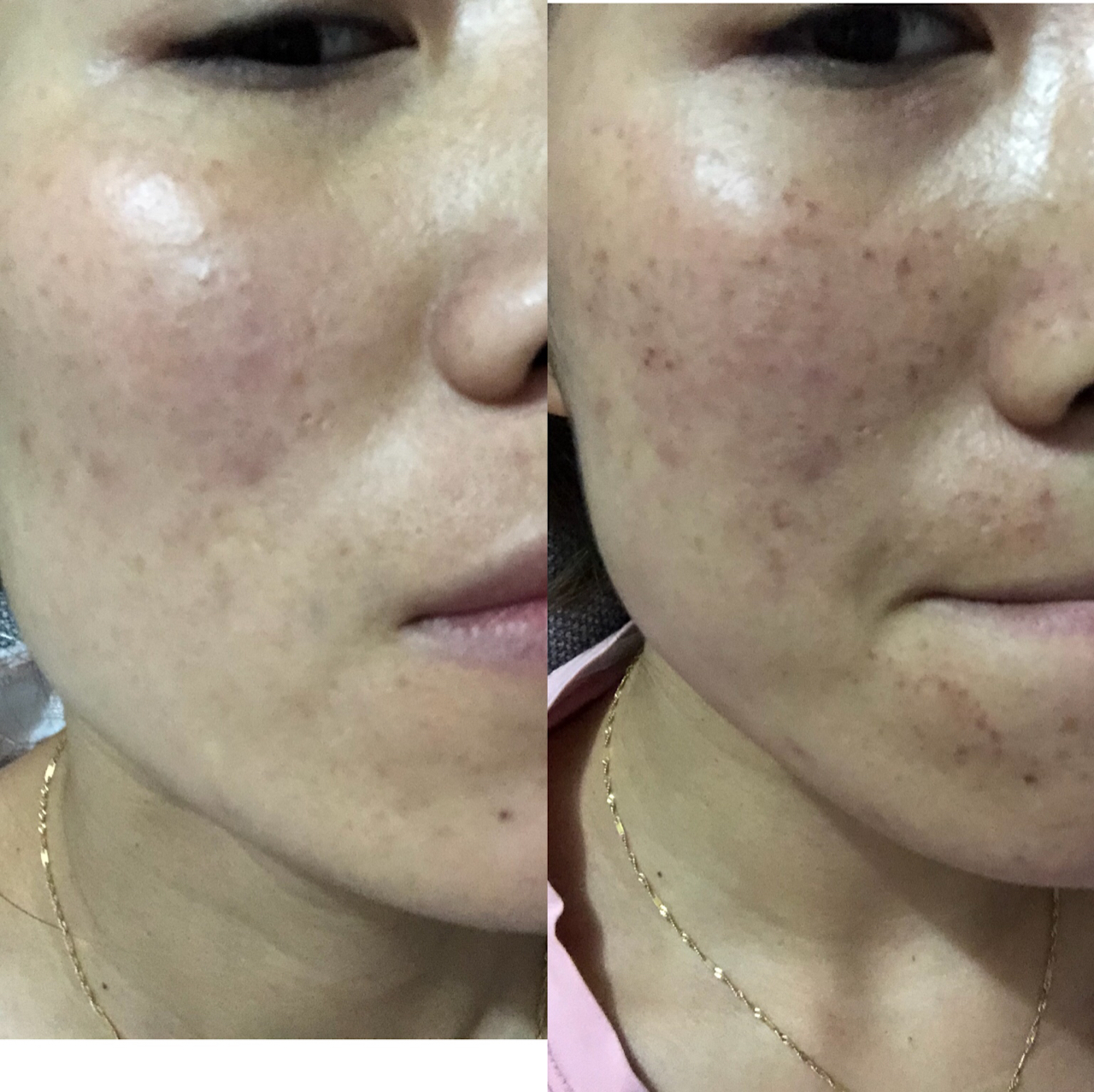 光子嫩膚一到七天圖，全面解析光子嫩膚過程與效果，全面解析光子嫩膚過程與效果，一到七天肌膚變化圖記錄光子嫩膚之旅