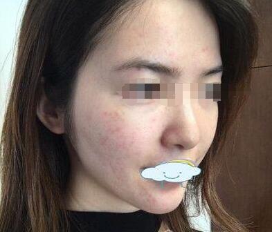 激光祛斑，維持美麗無瑕肌膚的持久之道，激光祛斑，持久維護(hù)美麗無瑕肌膚的秘訣