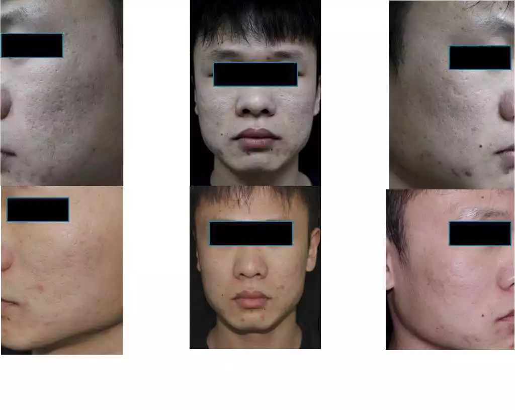 點陣激光去疤痕3次對比，效果與體驗分享，點陣激光三次祛疤對比，效果與親身體驗分享