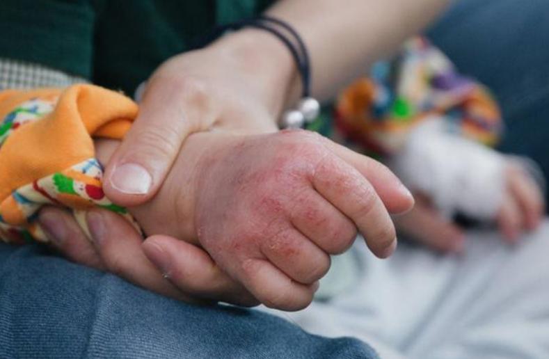 治療濕疹最有效的三個(gè)方法，濕疹治療三大有效方法全解析