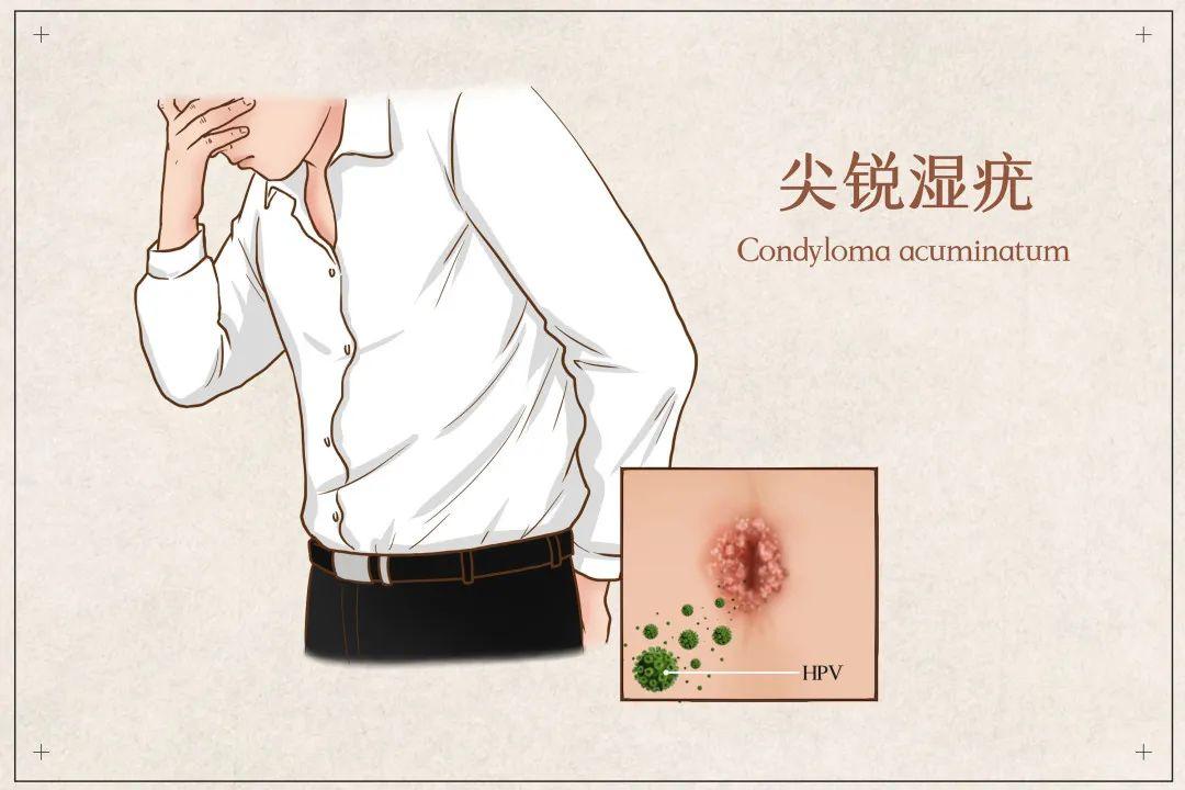 如何檢查自己是否有性疾病，全面指南，全面指南，如何檢查自己是否存在性疾病風(fēng)險(xiǎn)