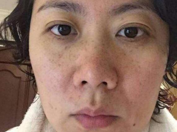 祛斑方法與技巧