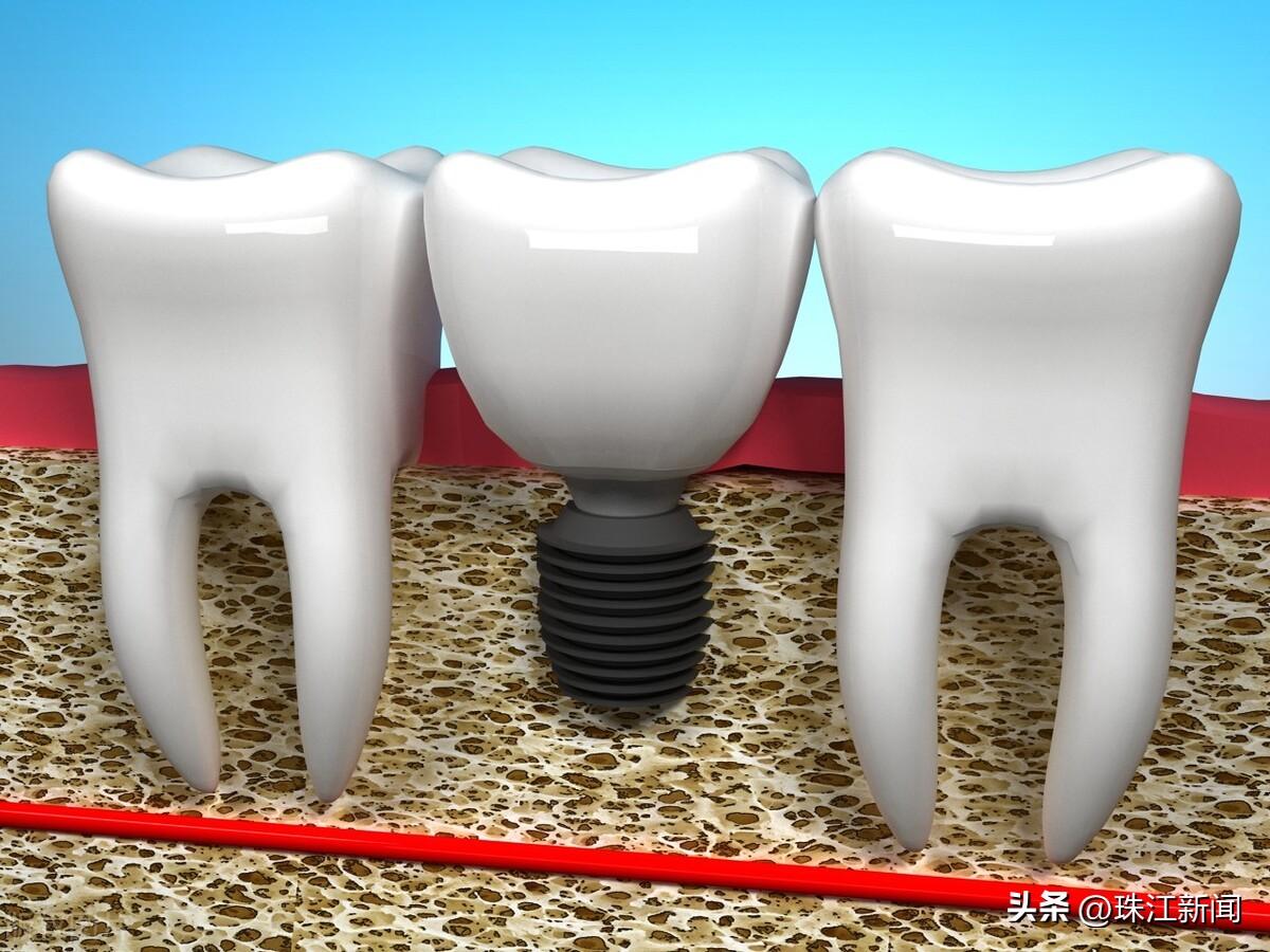 種植牙齒一般的價格及其相關(guān)因素解析，種植牙齒價格解析，影響因素詳解