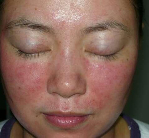 怎樣判斷是不是濕疹？全面解析濕疹癥狀與診斷方法，如何診斷濕疹？全面解析濕疹癥狀及診斷方法