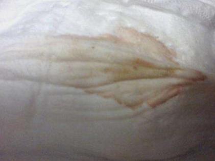 白帶發(fā)黃，了解原因與應(yīng)對措施，白帶發(fā)黃的原因及應(yīng)對措施解析