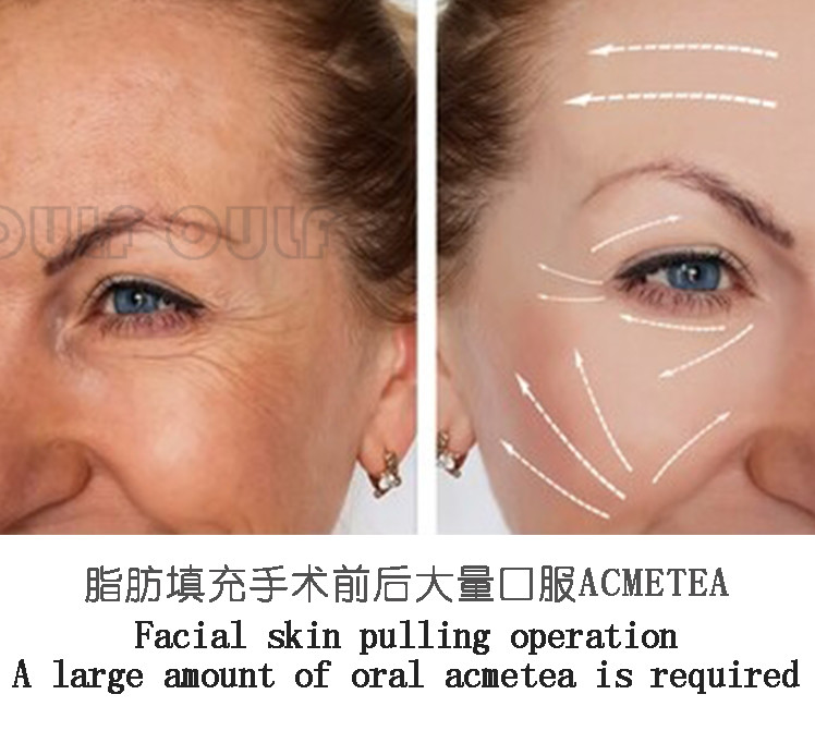 法令紋填充，價(jià)格與你的美麗之選，法令紋填充，美麗之選與價(jià)格考量