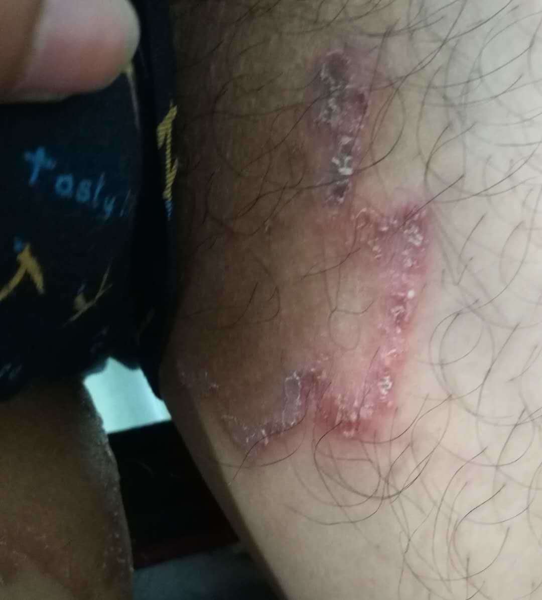 如何區(qū)分股癬與陰囊濕疹，癥狀、診斷與治療方法，股癬與陰囊濕疹，癥狀、診斷與治療方法詳解