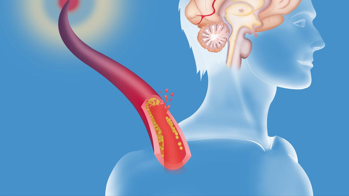 頸椎腦供血不足的癥狀及其影響，頸椎腦供血不足的癥狀及影響概述