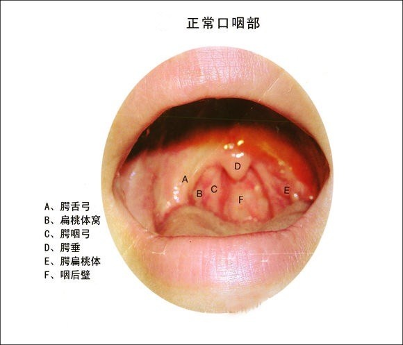 嗓子咽唾沫疼像刀割一樣的癥狀解析與治療建議，嗓子咽唾沫疼痛如刀割的癥狀解析及治療方案建議