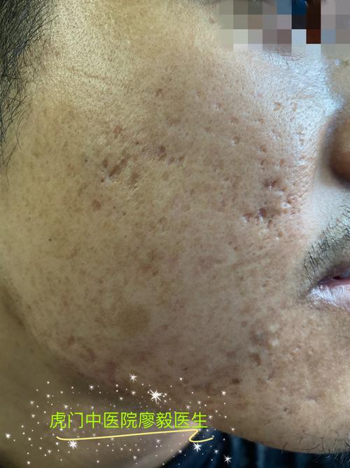 去痘坑修復(fù)凹洞手術(shù)費用詳解，痘坑修復(fù)手術(shù)費用詳解，了解凹洞修復(fù)手術(shù)費用全貌