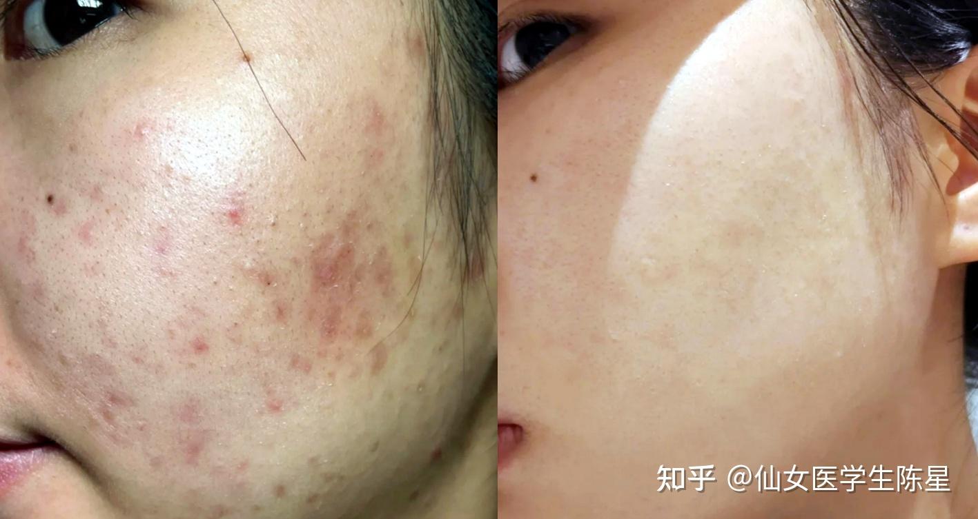 怎樣去除痘印，全面解析痘印消除方法與技巧，全面解析，如何有效去除痘印，痘印消除方法與技巧指南