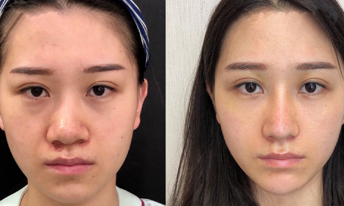 鼻翼縮小手術(shù)