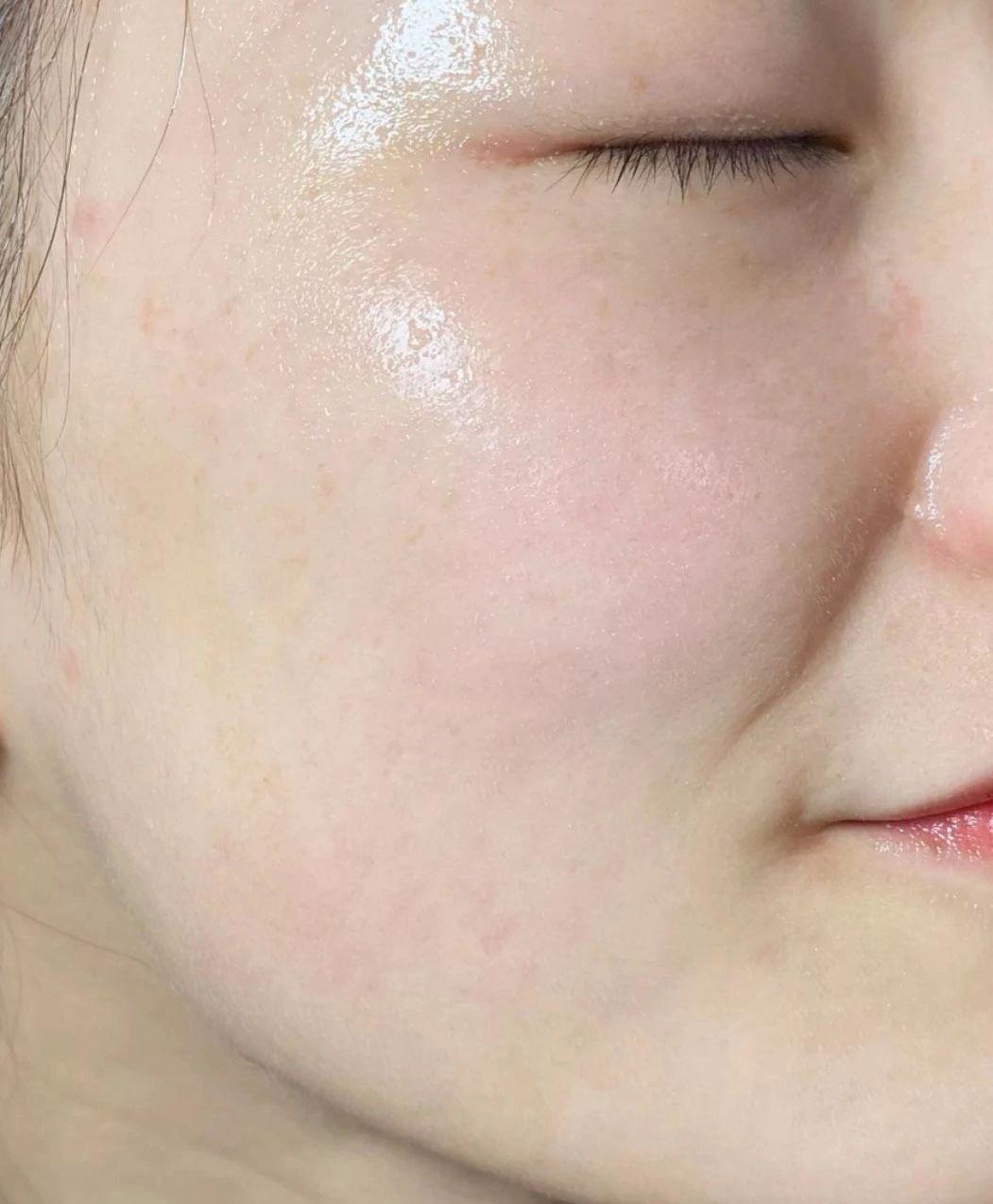 去除痘印最好的方法——專業(yè)指南與實(shí)用建議，專業(yè)指南與實(shí)用建議，去除痘印的最佳方法