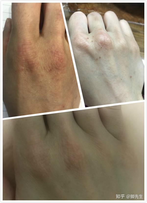 濕疹怎么才能根除，全面解析濕疹治療與預(yù)防策略，全面解析濕疹治療與預(yù)防策略，根除濕疹的有效方法探討