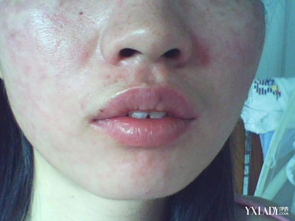 過敏性皮炎怎么治療好得快，全面解析有效方法，過敏性皮炎全面治療解析，快速有效的治療方法探討