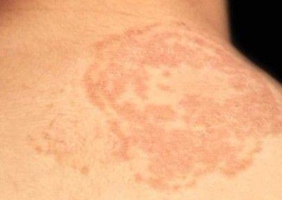 花斑癬圖片，了解病癥表現(xiàn)與防治方法，花斑癬圖片及病癥表現(xiàn)與防治方法解析