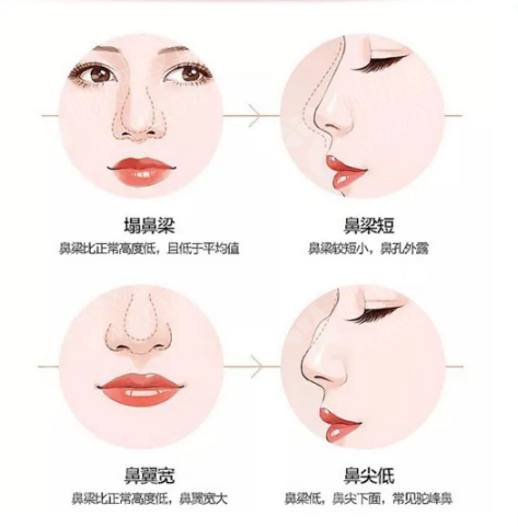 最安全的永久隆鼻，全面解析與指南，全面解析與指南，最安全的永久隆鼻方法