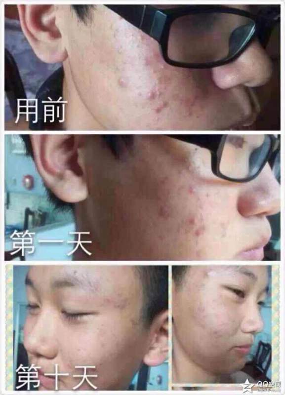 如何快速消除青春痘，方法與技巧，快速消除青春痘的方法與技巧