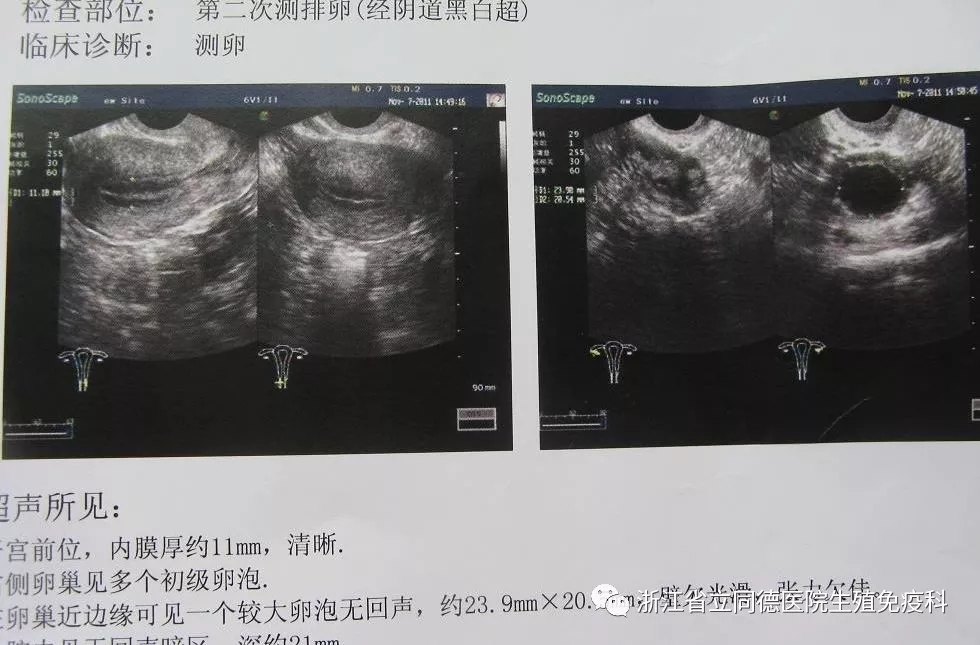 如何準(zhǔn)確判斷身體已經(jīng)成功排出卵子？全面解析排卵跡象與檢測方法，全面解析，如何判斷身體已成功排出卵子及排卵跡象與檢測方法