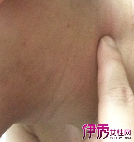 淋巴結(jié)腫大，十人九遇，如何應(yīng)對(duì)？，如何應(yīng)對(duì)常見淋巴結(jié)腫大問題？