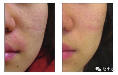 光子嫩膚的危害十年，深入了解與預(yù)防措施，光子嫩膚十年危害揭秘，深入了解與預(yù)防措施