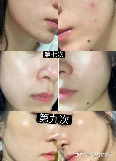 光子嫩膚一年做幾次，專業(yè)建議與注意事項(xiàng)，專業(yè)解析，光子嫩膚的適宜頻率及注意事項(xiàng)