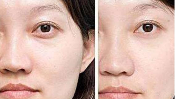 面癱恢復(fù)正常的周期，了解與應(yīng)對(duì)，面癱恢復(fù)正常的周期詳解及應(yīng)對(duì)策略