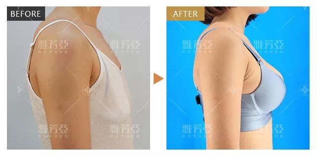 自體脂肪豐胸過(guò)程中的痛苦體驗(yàn)及應(yīng)對(duì)方法，自體脂肪豐胸過(guò)程中的痛苦體驗(yàn)如何應(yīng)對(duì)？