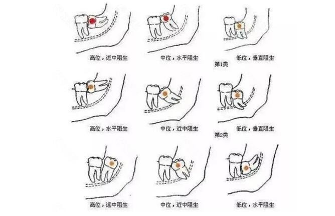 拔智齒一顆牙多少錢？全面了解智齒拔除費(fèi)用及因素，智齒拔除費(fèi)用全解析，智齒拔除一顆需要多少錢？了解費(fèi)用因素與細(xì)節(jié)