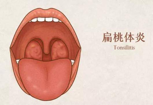 關(guān)于扁桃體發(fā)炎的十大禁忌事項(xiàng)，扁桃體炎患者的十大禁忌事項(xiàng)