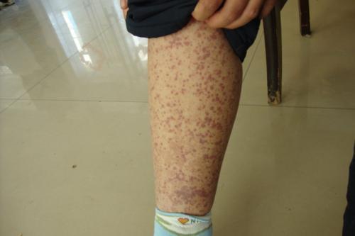 紫癜，深入了解與治療選擇，紫癜，全面解析與治療策略