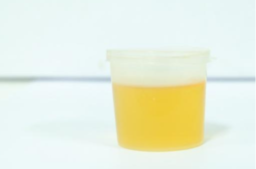 尿液發(fā)黃是什么原因，深度解析與應(yīng)對(duì)建議，尿液發(fā)黃的原因深度解析及應(yīng)對(duì)建議