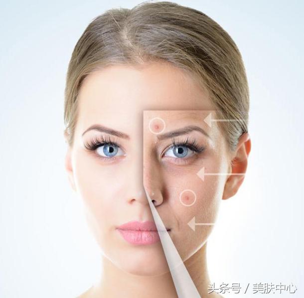 如何去除痘印，最有效的方法和建議，如何有效去除痘印，方法與建議全解析