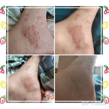 濕疹治療