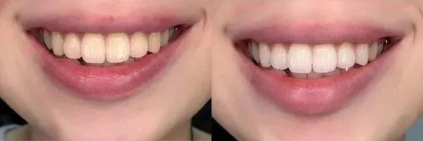牙齒黃了怎么變白最簡(jiǎn)單的方法，牙齒變黃如何簡(jiǎn)單美白？有效方法大揭秘