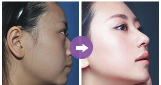 鼻頭鼻翼縮小手術(shù)費(fèi)用詳解，多少錢才能實(shí)現(xiàn)美麗轉(zhuǎn)變？，鼻頭鼻翼縮小手術(shù)費(fèi)用全解析，實(shí)現(xiàn)美麗轉(zhuǎn)變需要多少錢？