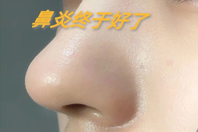 斑禿最簡(jiǎn)單的恢復(fù)辦法，斑禿恢復(fù)秘籍，輕松應(yīng)對(duì)斑禿，簡(jiǎn)單有效方法揭秘！