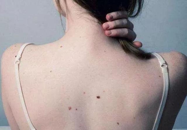 長痘痘了怎么消除，全方位指南與實(shí)用建議，全方位指南，如何消除痘痘，實(shí)用建議助你擺脫困擾