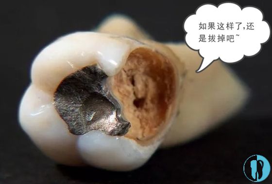 后悔把爛牙根拔了嗎？解讀牙齒拔除的利弊與決策過(guò)程，后悔拔爛牙根了嗎？牙齒拔除的利弊分析與決策過(guò)程解讀