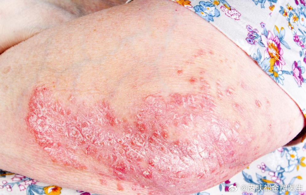 濕疹不治療會自愈嗎？深入了解濕疹及其自然康復(fù)可能性，濕疹不治療會自愈嗎？探究濕疹的自然康復(fù)可能性