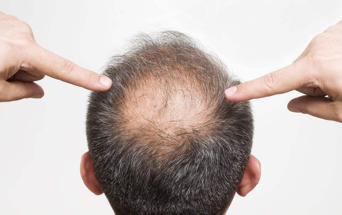 脫發(fā)的原因及其影響因素，深度解析，深度解析脫發(fā)原因及其影響因素