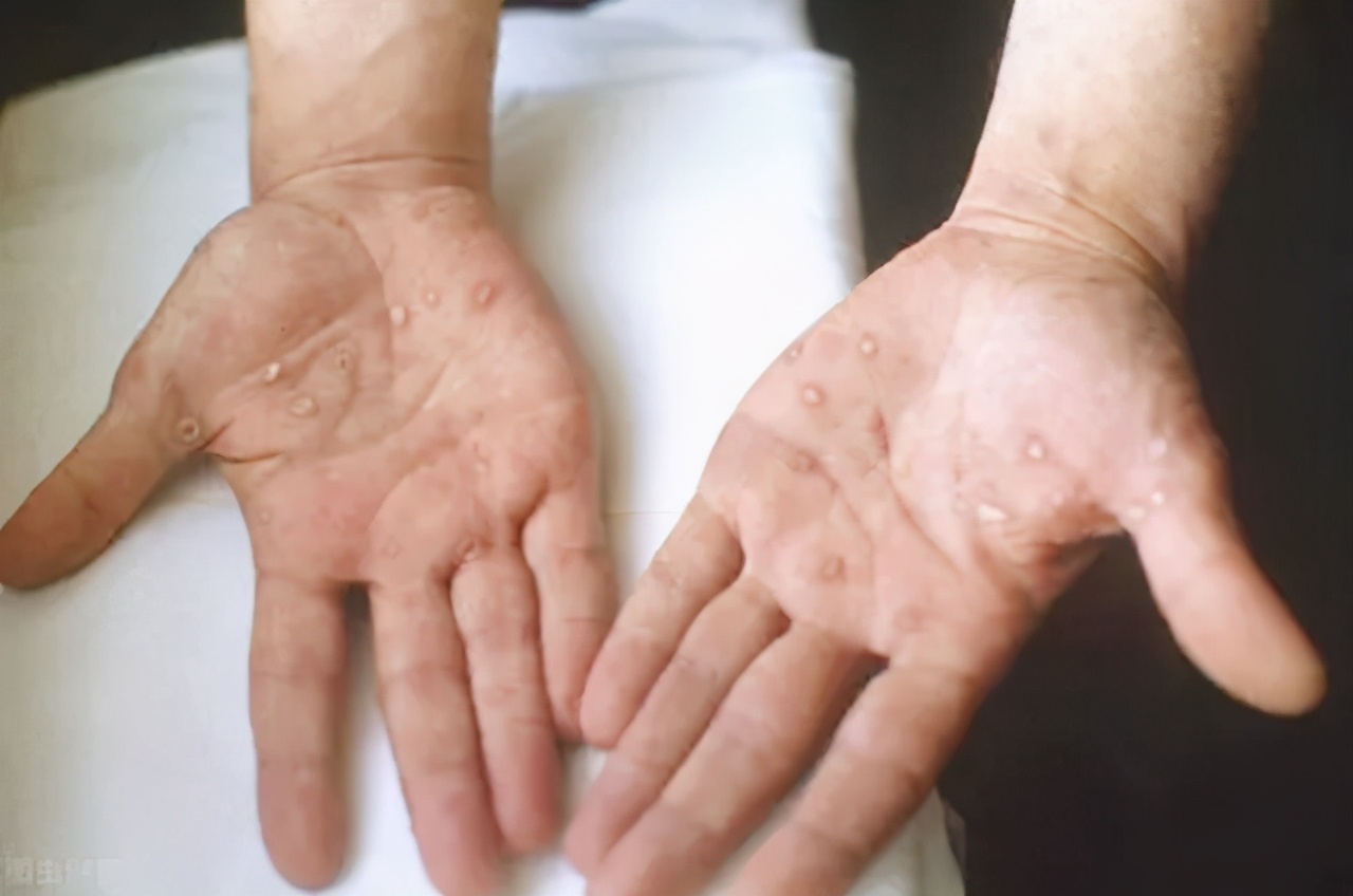 梅毒與艾滋病的關(guān)聯(lián)，深入了解疾病風(fēng)險(xiǎn)與預(yù)防措施，梅毒與艾滋病，關(guān)聯(lián)、風(fēng)險(xiǎn)及預(yù)防措施解析