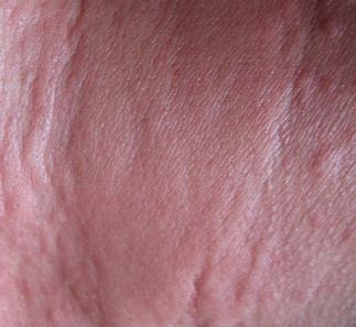 揭秘蕁麻疹突發(fā)背后的原因，為什么會(huì)突然得了蕁麻疹？，揭秘蕁麻疹突發(fā)背后的原因，探尋蕁麻疹突然發(fā)作的原因與機(jī)制