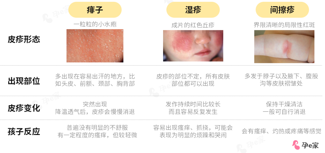 痱子和濕疹的區(qū)別圖片，深入了解兩種常見(jiàn)皮膚狀況，痱子和濕疹的區(qū)別詳解，圖片解析兩種常見(jiàn)皮膚狀況