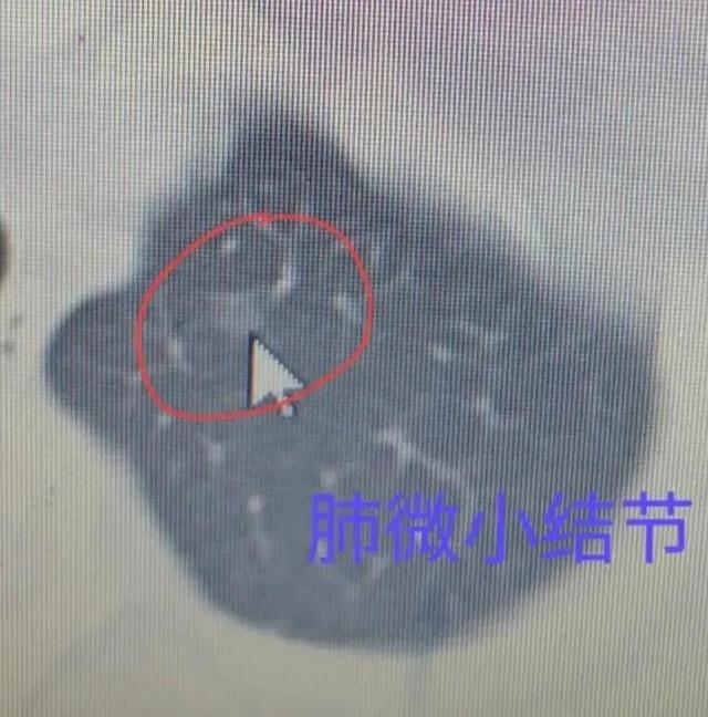 消除肺結(jié)節(jié)的最佳方法，消除肺結(jié)節(jié)的最佳方法解析