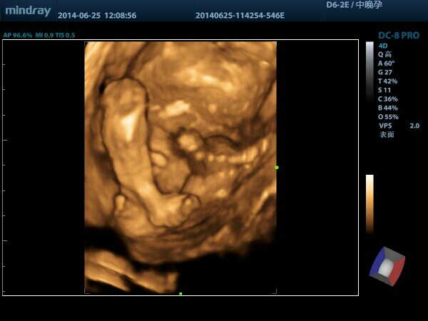 四維彩超如何解讀男女之別，四維彩超解讀男女之別的方法與技巧