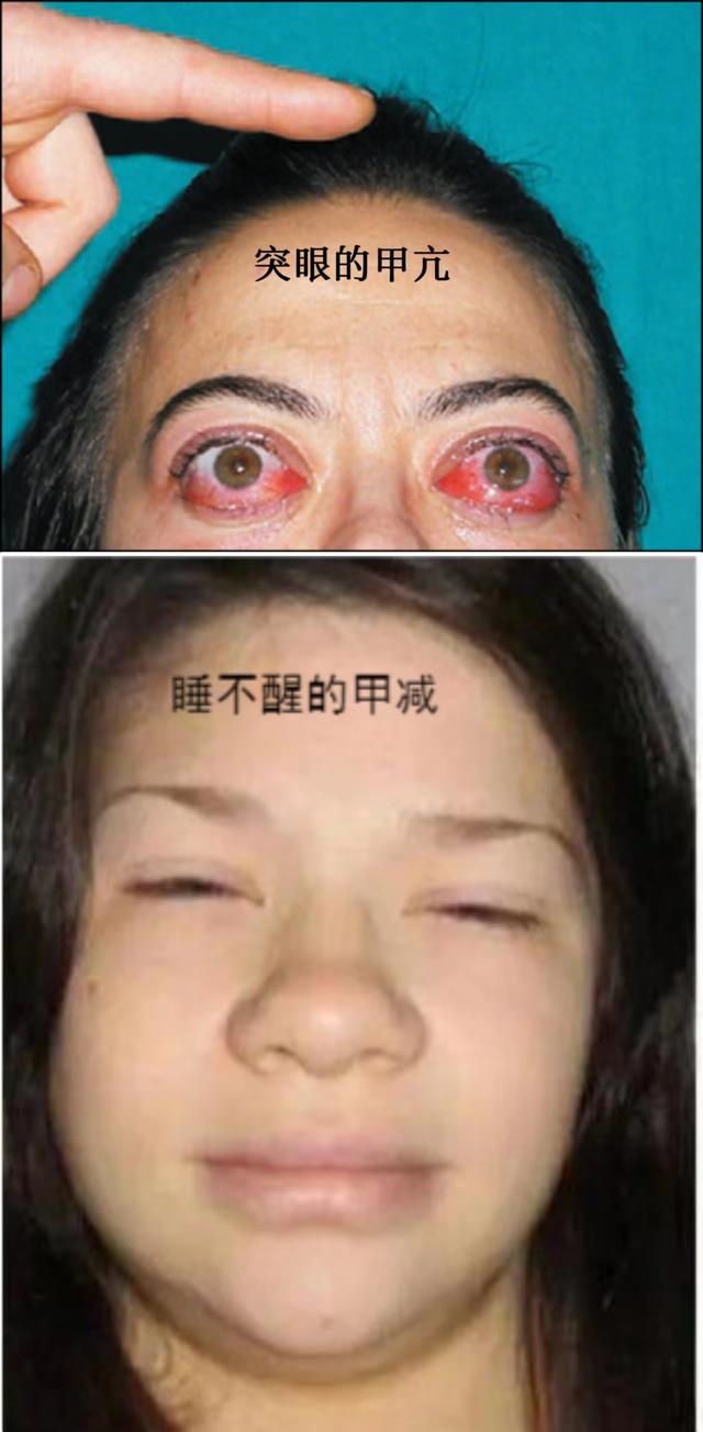 甲亢病人飲食禁忌一覽表，甲亢病人飲食禁忌大全