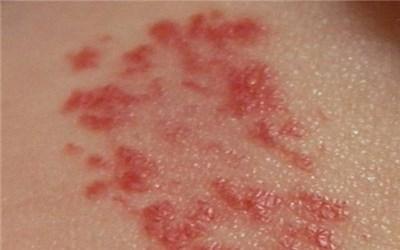 不痛不癢的小紅點(diǎn)圖片，探索皮膚現(xiàn)象的奧秘，皮膚小紅點(diǎn)之謎，探索不痛不癢小紅點(diǎn)的奧秘圖片解析