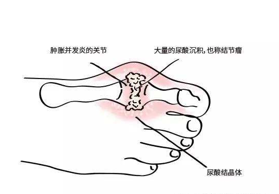 痛風(fēng)的幾個(gè)常見部位圖片及其相關(guān)知識(shí)解析，痛風(fēng)常見發(fā)病部位圖解與相關(guān)知識(shí)解析